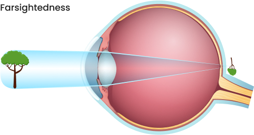 Farsightedness img